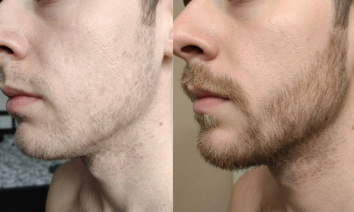 Customer beard before and after using Buddy Beard oil