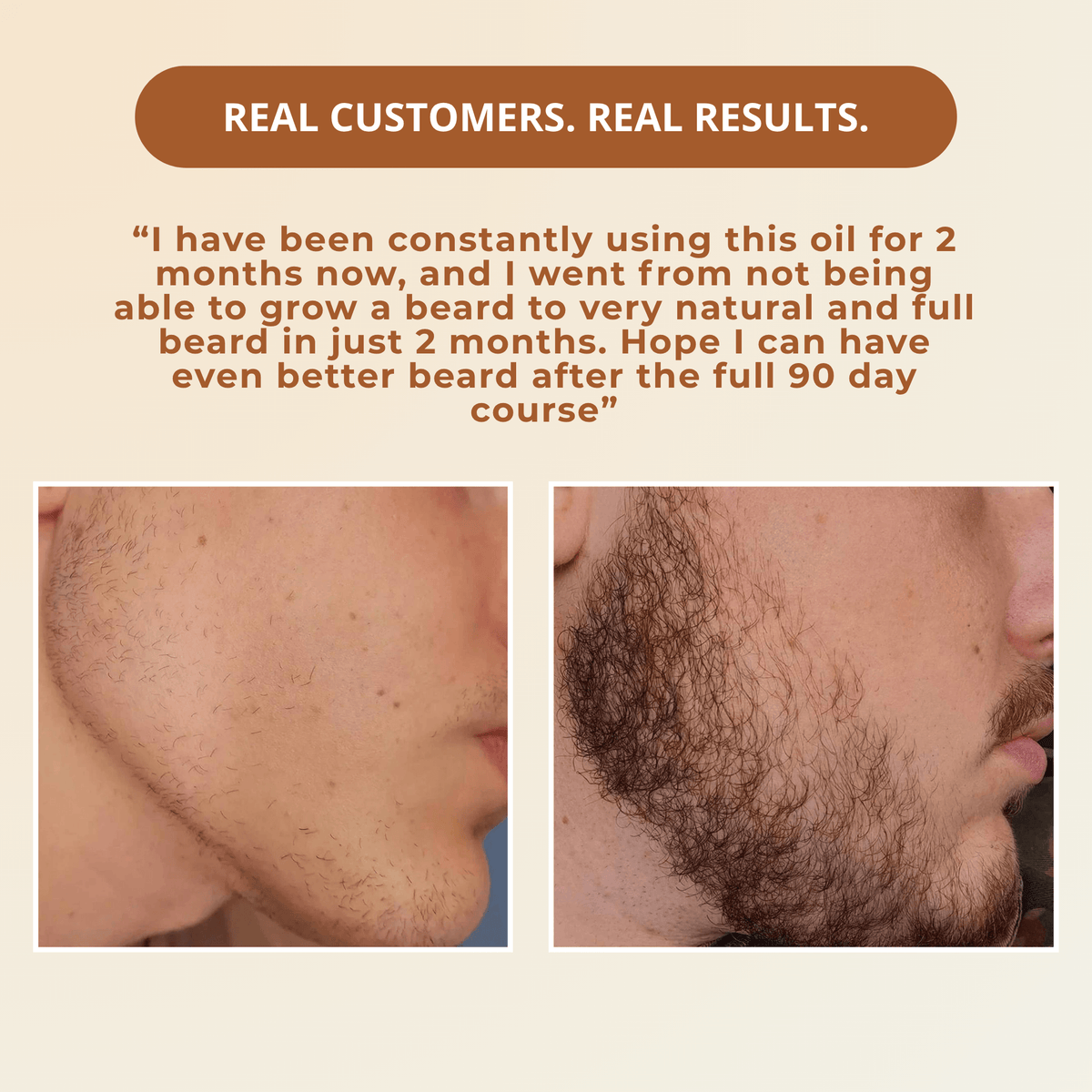 Before and after comparison of a customer's beard growth after 2 months.